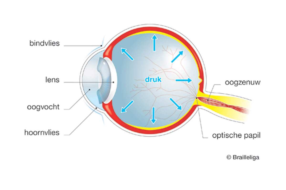 Glaucoom – Achtergrond – Hemmer Optiek & Optometrie