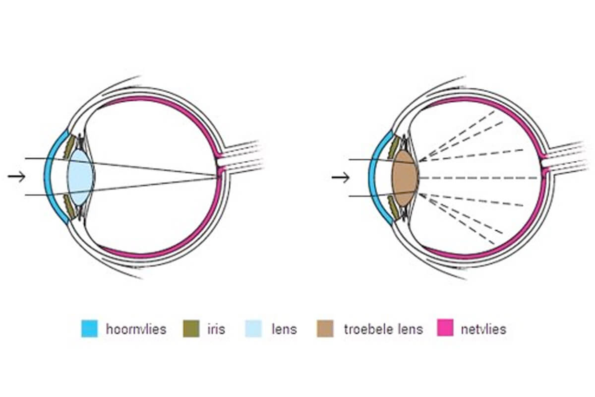 Staar – Achtergrond – Hemmer Optiek & Optometrie